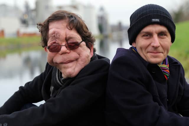 Adam Pearson Says Actors with Disabilities Are Typecast
