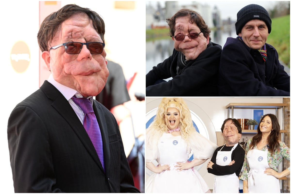 Adam Pearson Says Actors with Disabilities Are Typecast